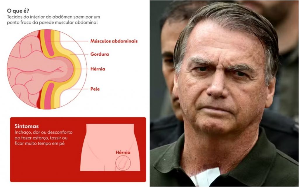 "Cirurgia finalizada con éxito"como Michelle; Bolsonaro ya no está en cuarto, dicen los médicos