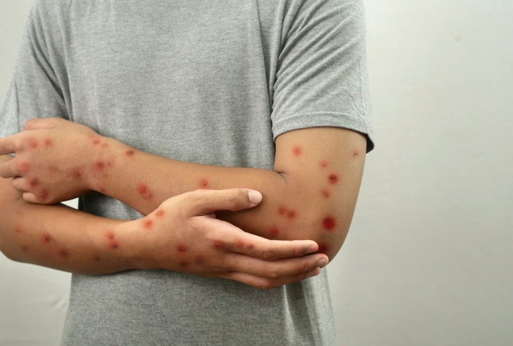 La Red Mundial de Virus advierte sobre el resurgimiento del sarampión e insta a reforzar la vacunación