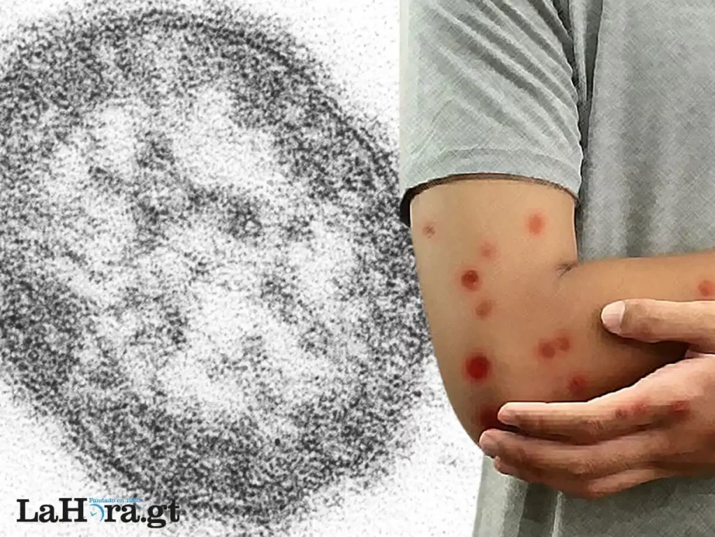 Alerta de la OPS por sarampión permite a Guatemala mayor vigilancia y respuesta sanitaria de posibles brotes Alerta de la OPS por sarampión permite a Guatemala mayor vigilancia y respuesta sanitaria de posibles brotes