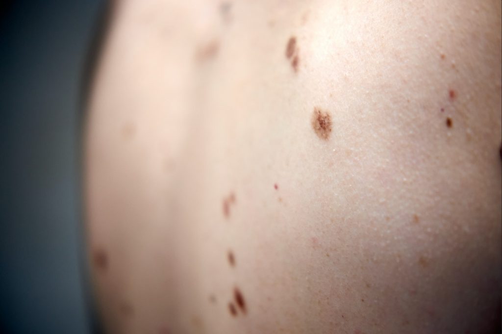 Cáncer de piel en Chile