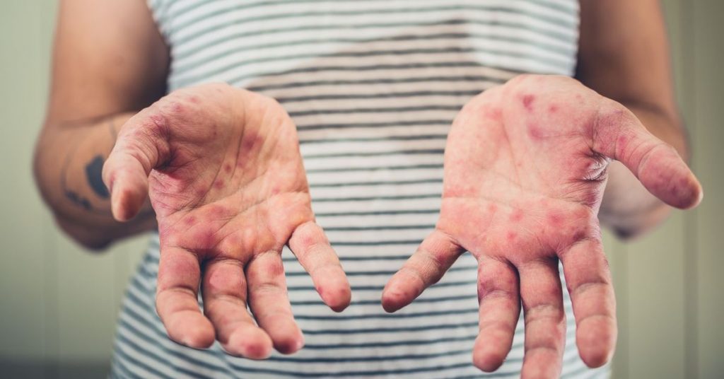 Panamá cumple más de 30 años sin casos de sarampión y refuerza vigilancia ante alerta regional - Nacionales